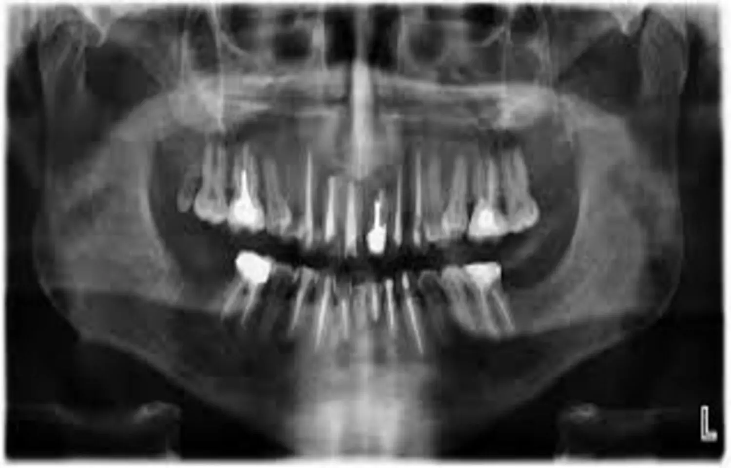 Patients with X-linked hypophosphatemia more prone to spontaneous dental abscesses and periodontal disease: Study