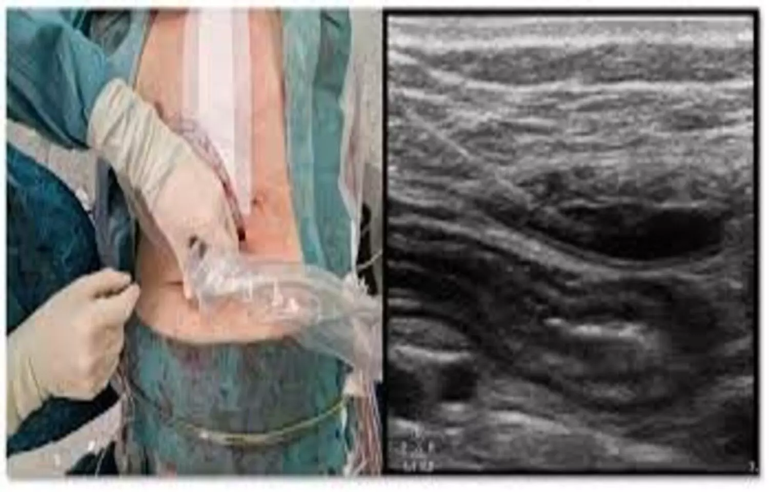 Rectus Sheath Block effective Anesthesia for open umbilical hernia repair: Study Rectus Sheath Block effective Anesthesia for open umbilical hernia repair: Study
