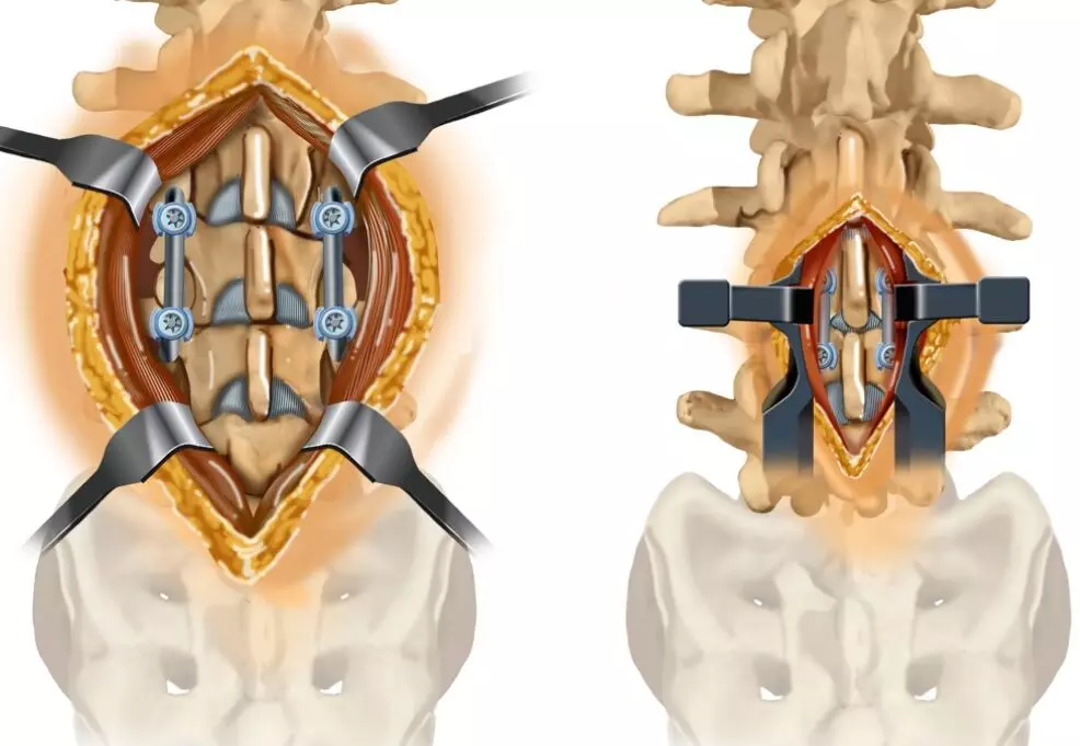 Guidewireless awl technique offers highly time-efficient alternative for navigated pedicle screw insertion in spine surgeries: study