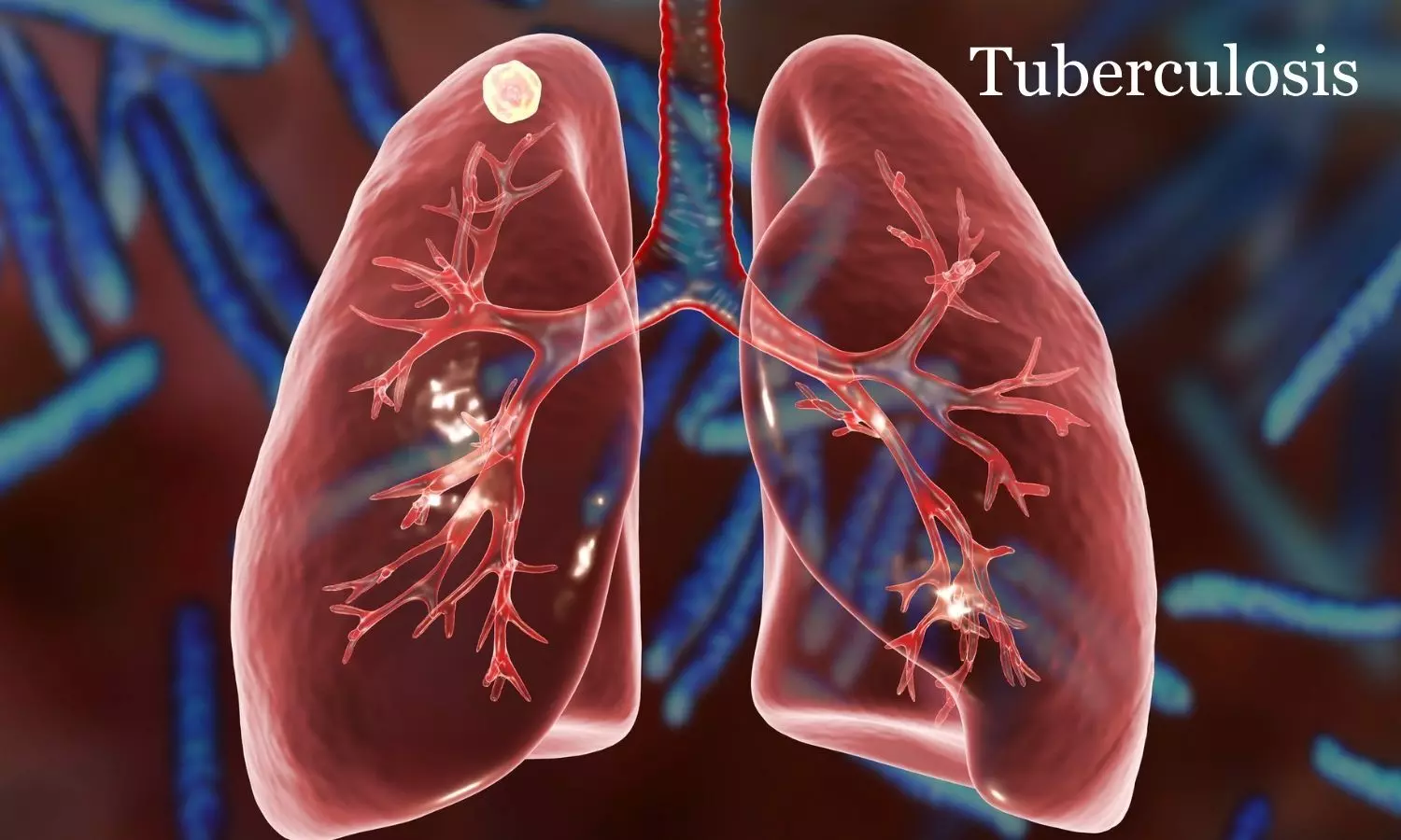 Pulmonary Tuberculosis Sequelae Mask Late-Onset Kartagener’s Syndrome: Case Report