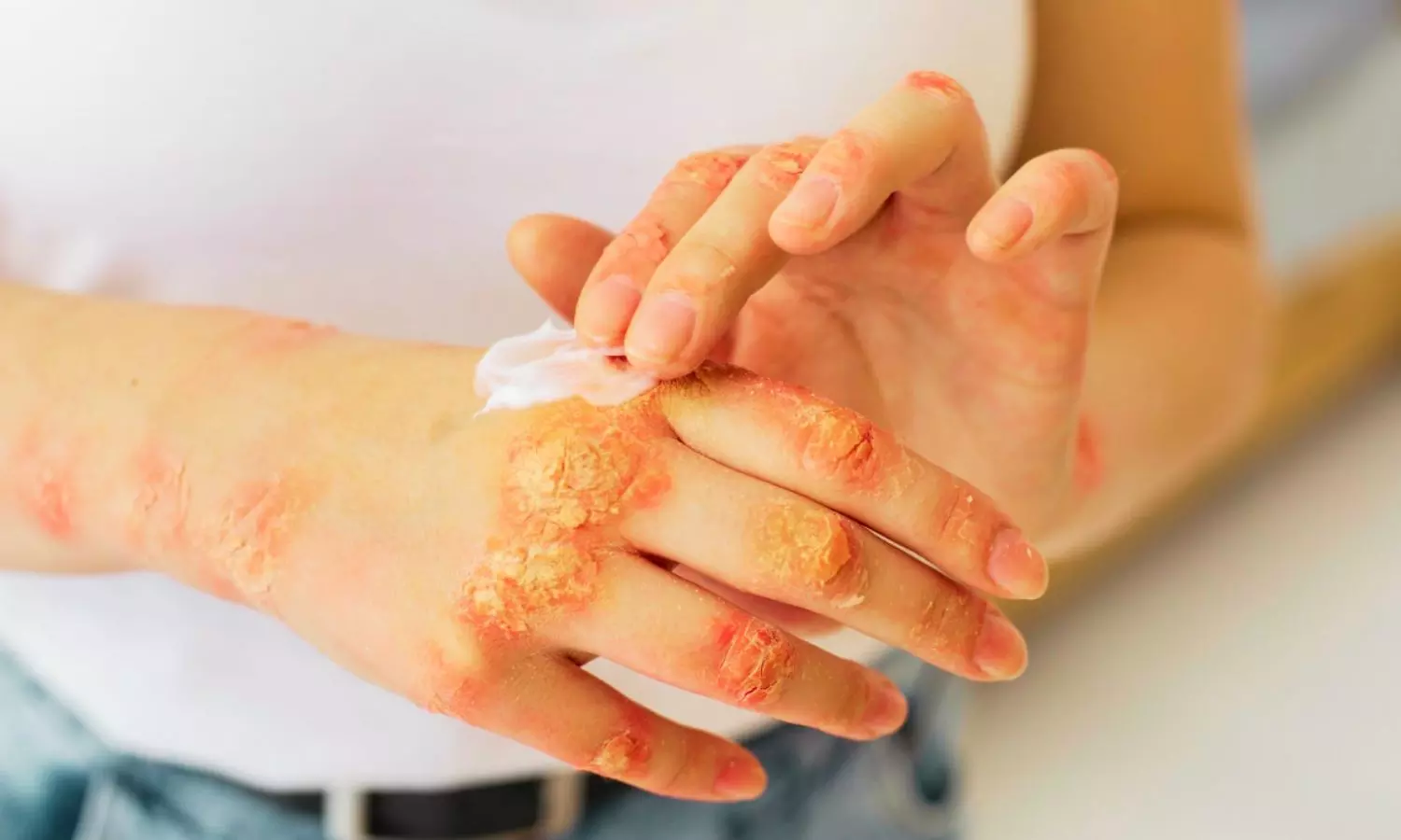 Dermabrasion with Split-Thickness Skin Grafting Tied to Better Scar Outcomes in Post-Burn Leukoderma: Study