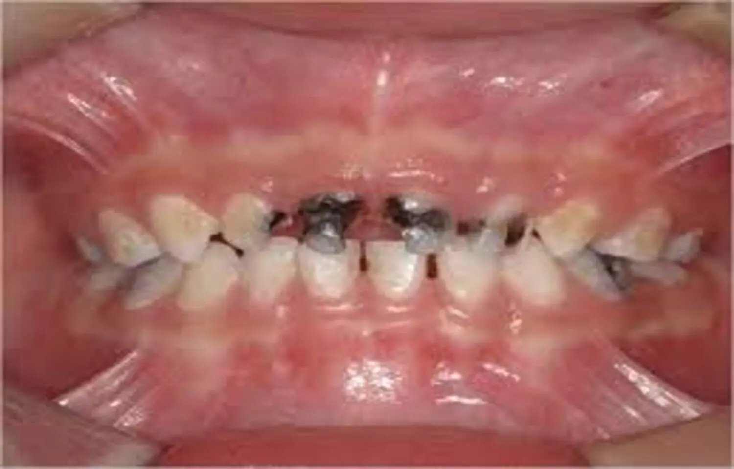 Intensive fluoride Varnish application has no impact on Oral Microbiome in kids with untreated ECC: Study