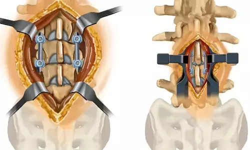 Guidewireless awl technique offers highly time-efficient alternative for navigated pedicle screw insertion in spine surgeries: study