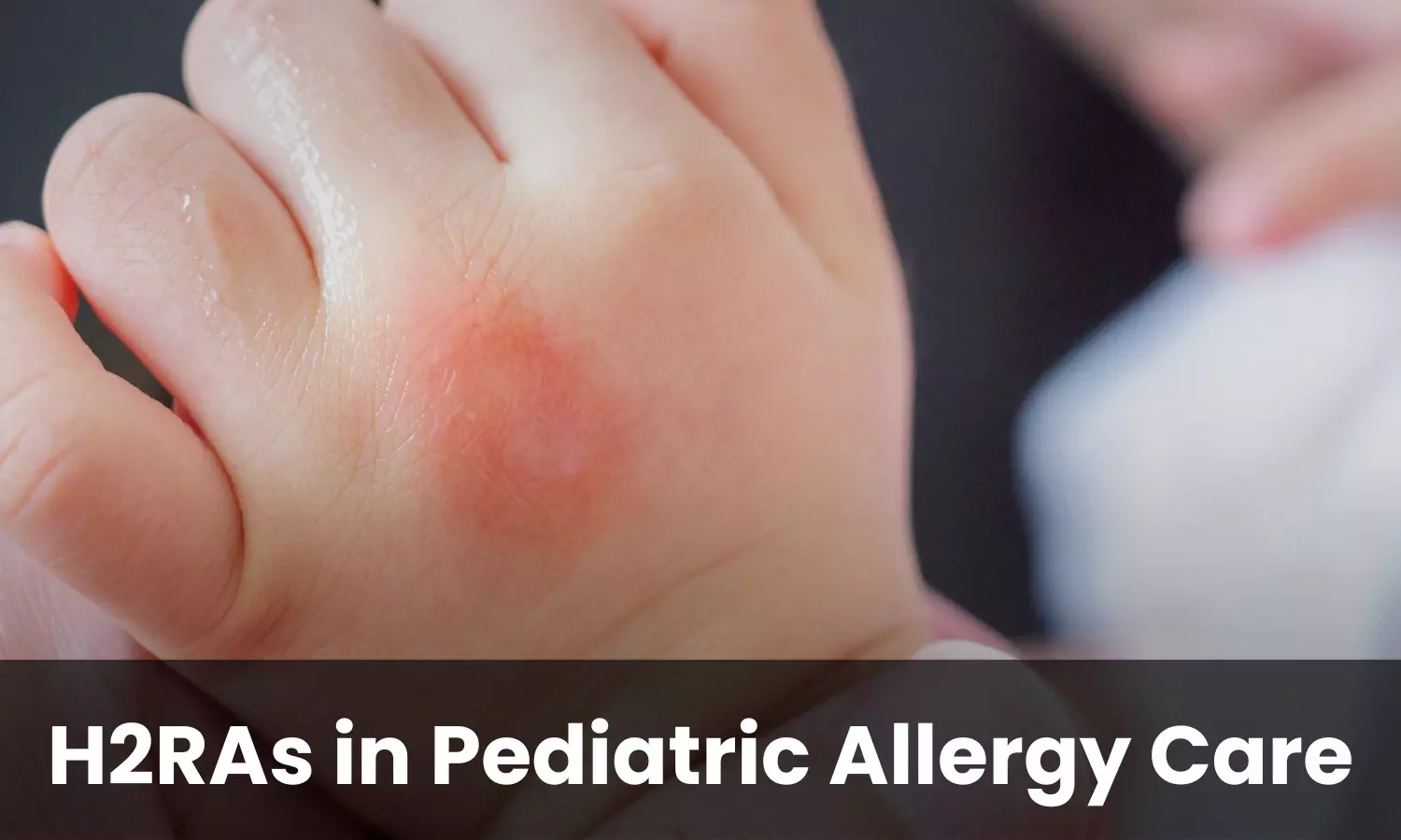 Considering H2RAs in Management of Pediatric Allergic Conditions: A Multidisciplinary Consensus