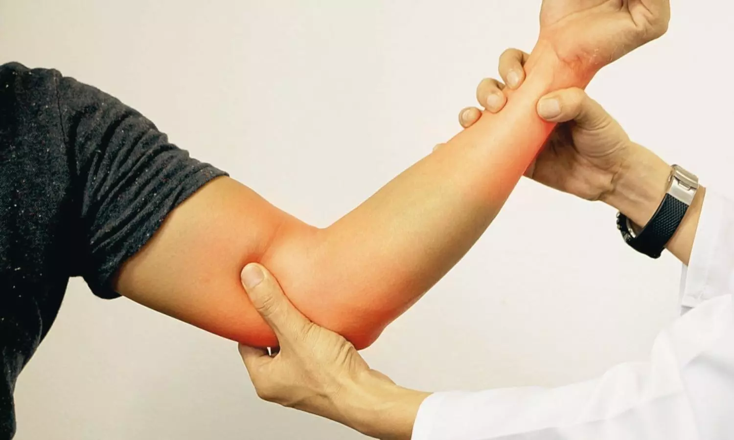 Polyethylene Glycol–Mediated Nerve Repair Improves Early Recovery in Severe Nerve Injuries: Study