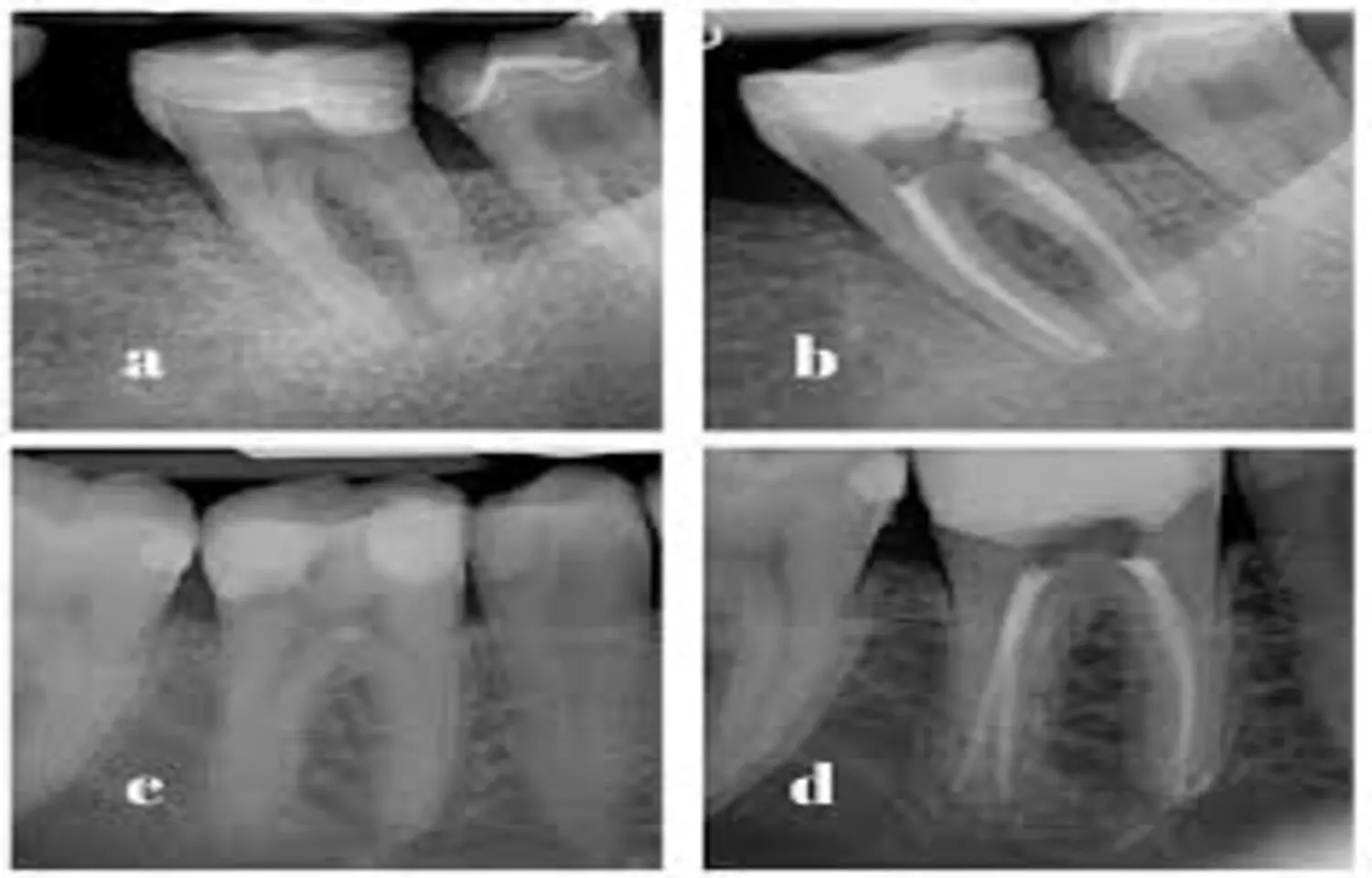 Different  Root Canal Sealers exhibit  no significant differences in Postoperative Pain in pulpitis: Study