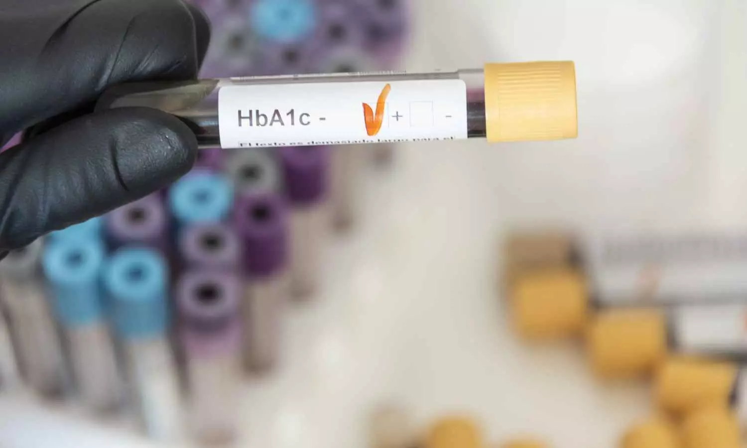 TyG Index Linked to CAD Risk Partially Mediated by HbA1c: Study