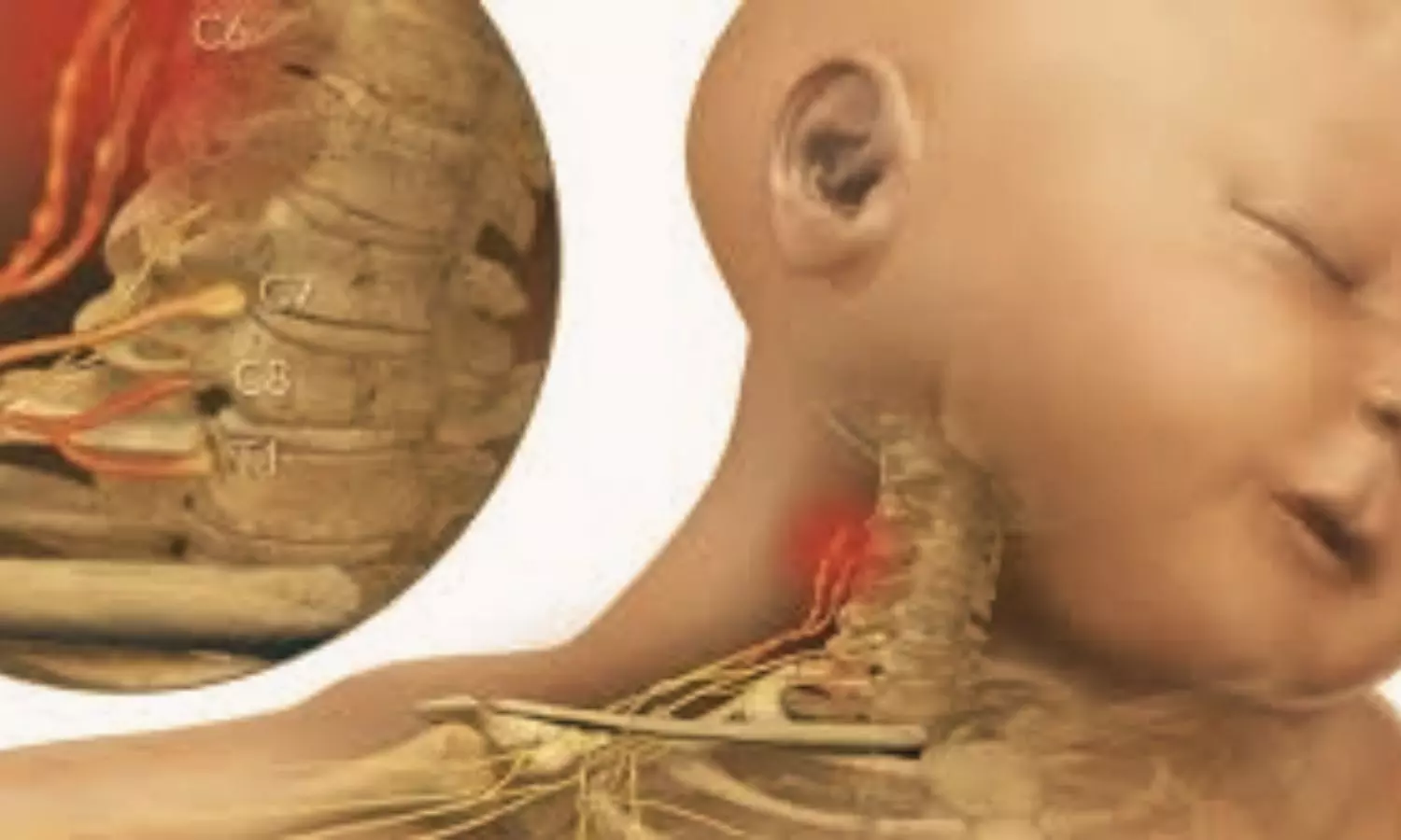 Brachial Plexus Birth Injury May Reduce QoL in Childhood Due to Psychosocial Factors and Pain: JAMA