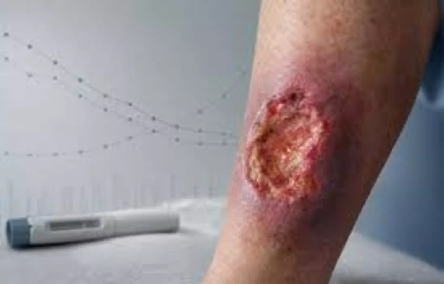 Adalimumab Shown Effective and Safe in Pyoderma Gangrenosum in real world study