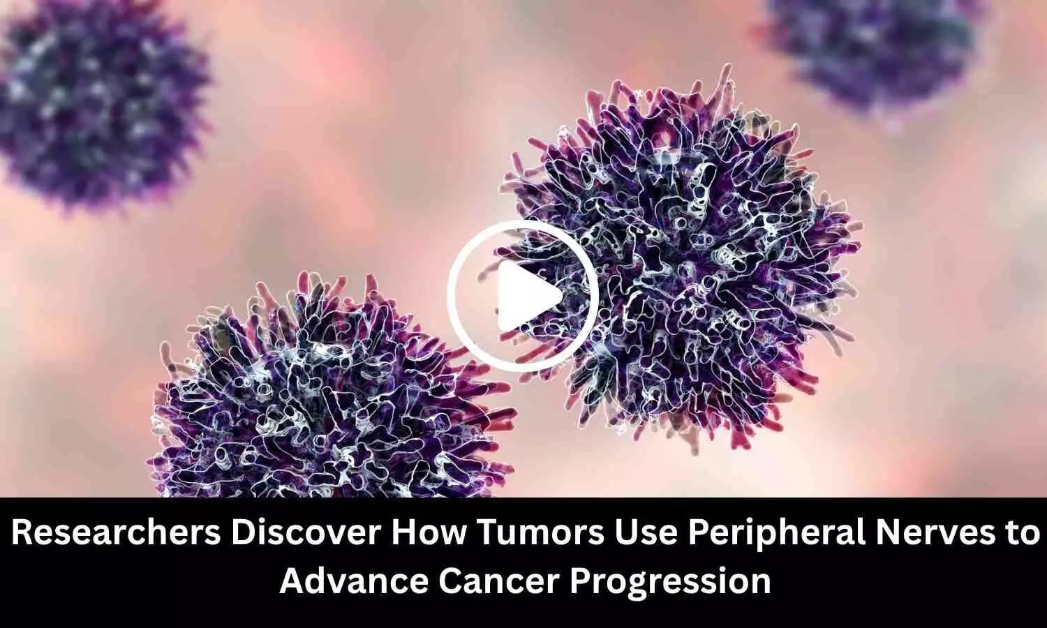 Researchers Discover How Tumors Use Peripheral Nerves to Advance Cancer Progression