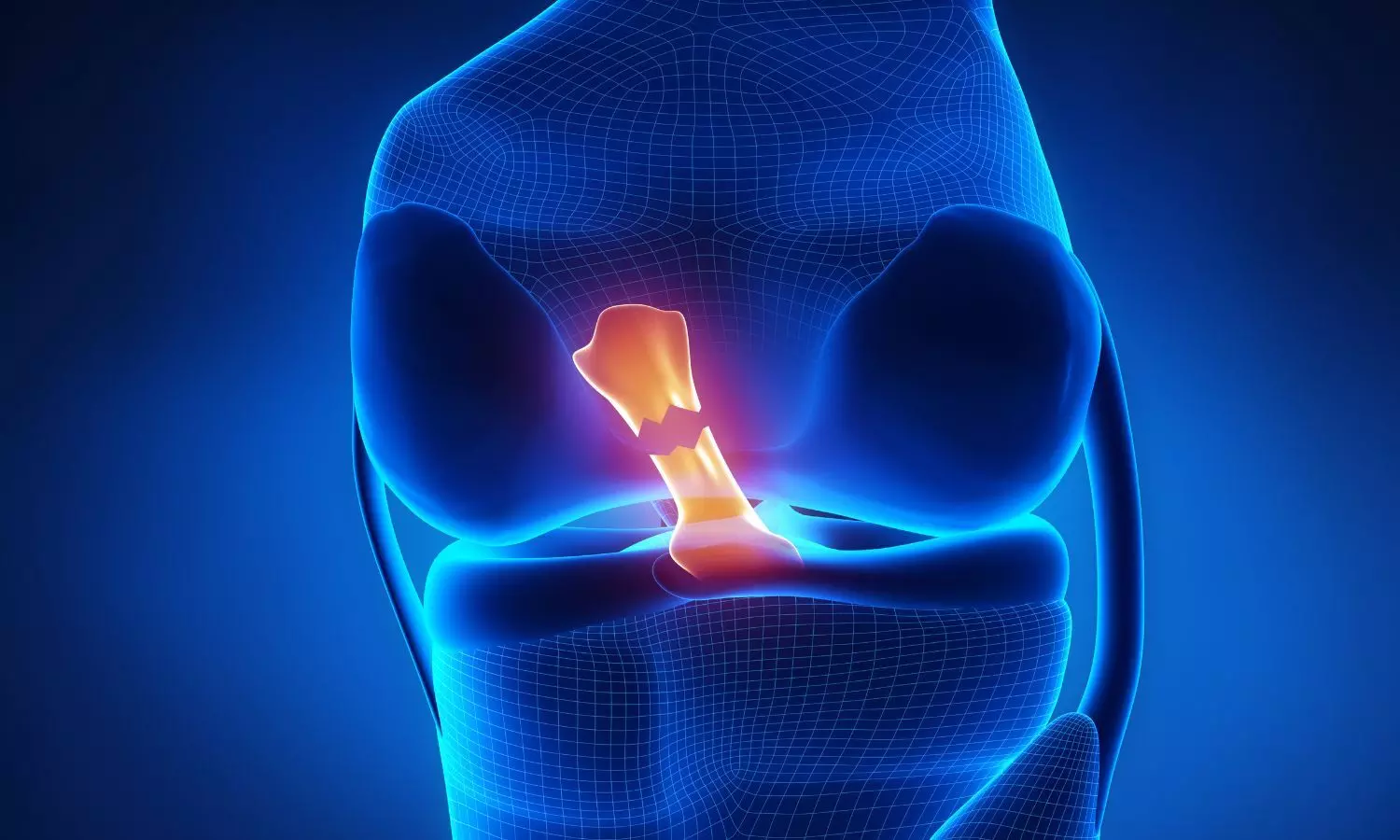 Study finds new ACL surgery approach helps most patients return to activity
