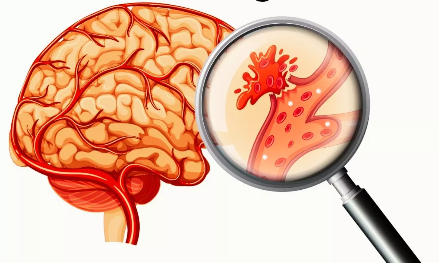 High Mortality Risk of Hemorrhagic Stroke with Warfarin After Mechanical Valve Replacement, Finds Study High Mortality Risk of Hemorrhagic Stroke with Warfarin After Mechanical Valve Replacement, Finds Study