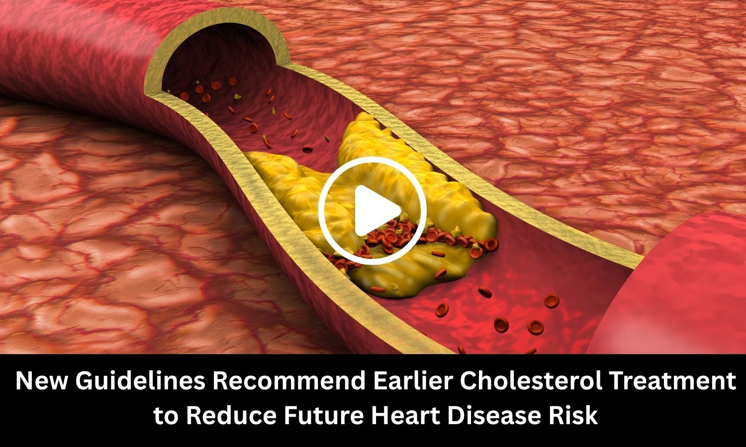 New Guidelines Recommend Earlier Cholesterol Treatment to Reduce Future ...