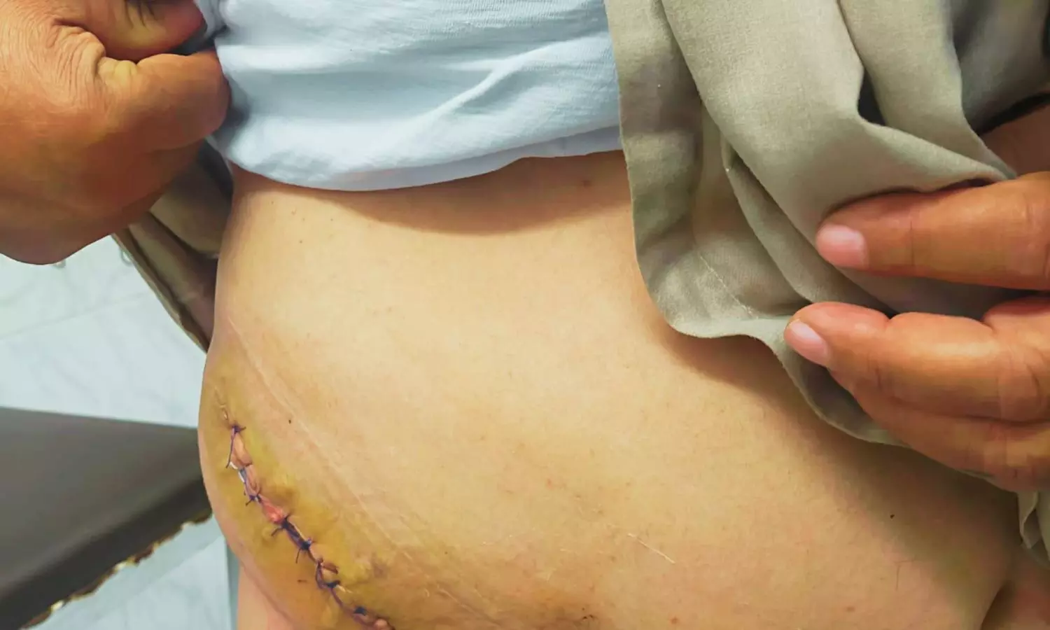 Sandwich Mesh Technique Shows Promise for Lumbar Incisional Hernia Repair: Case Series Reveals