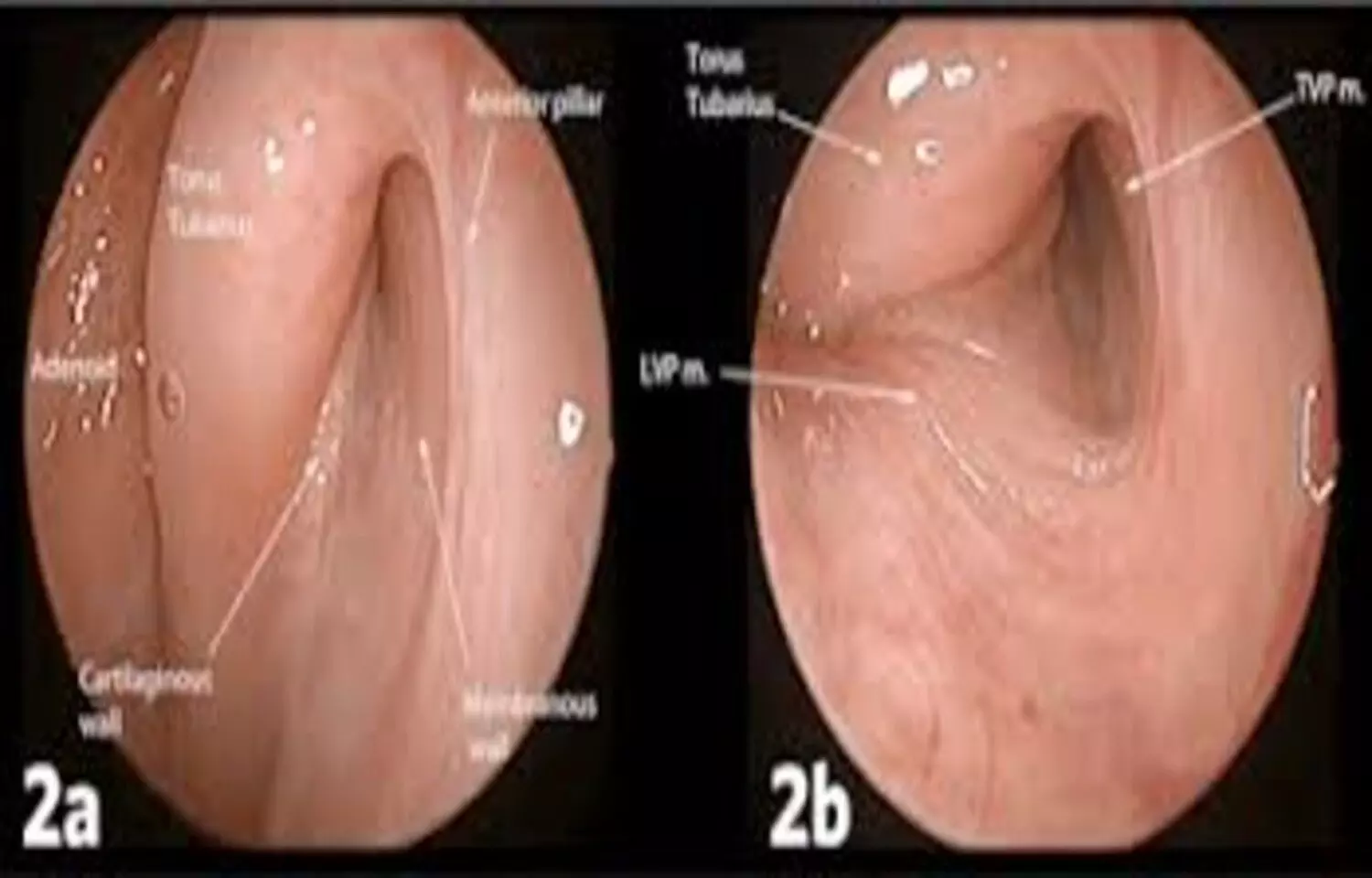 Turbinate Surgery May Increase Risk of Patulous Eustachian Tube, reports case study Turbinate Surgery May Increase Risk of Patulous Eustachian Tube, reports case study