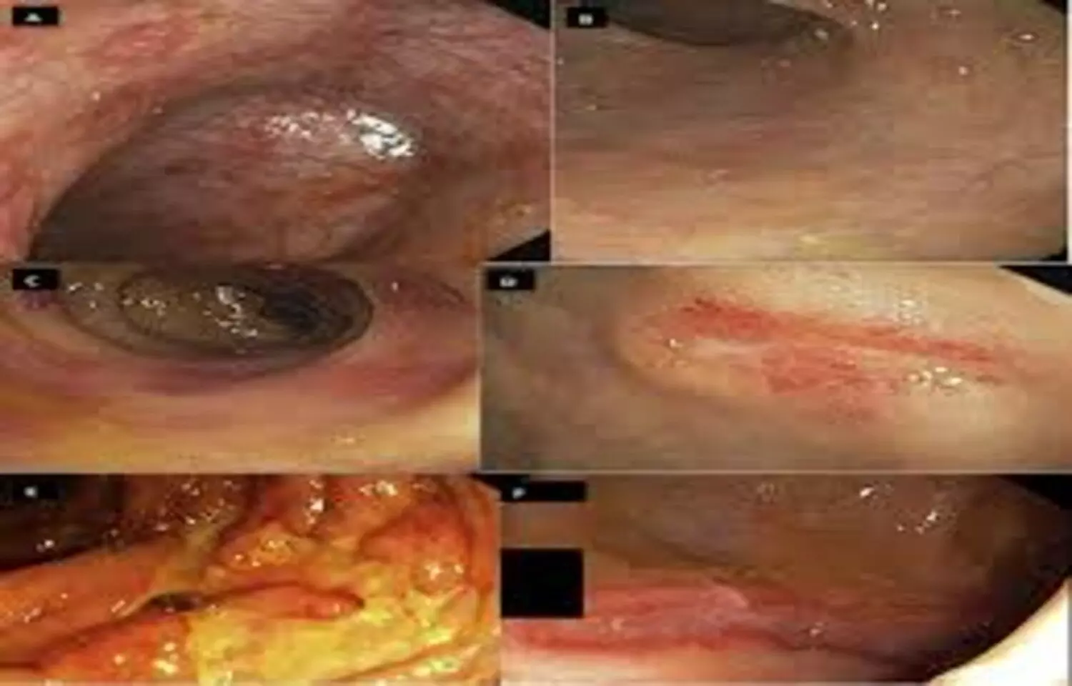 Small Bowel Lesions: An Underrecognized Cause of GI Bleeding in Hemodialysis Patients: Study