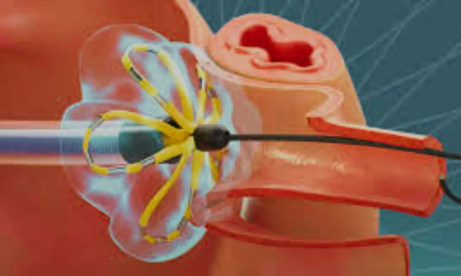 Low Haptoglobin Linked to Early Renal Injury After PFA: Study Low Haptoglobin Linked to Early Renal Injury After PFA: Study