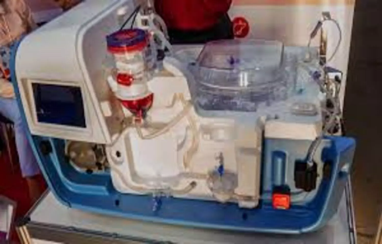 HOPE Perfusion Improves Outcomes After Liver Transplantation: JAMA