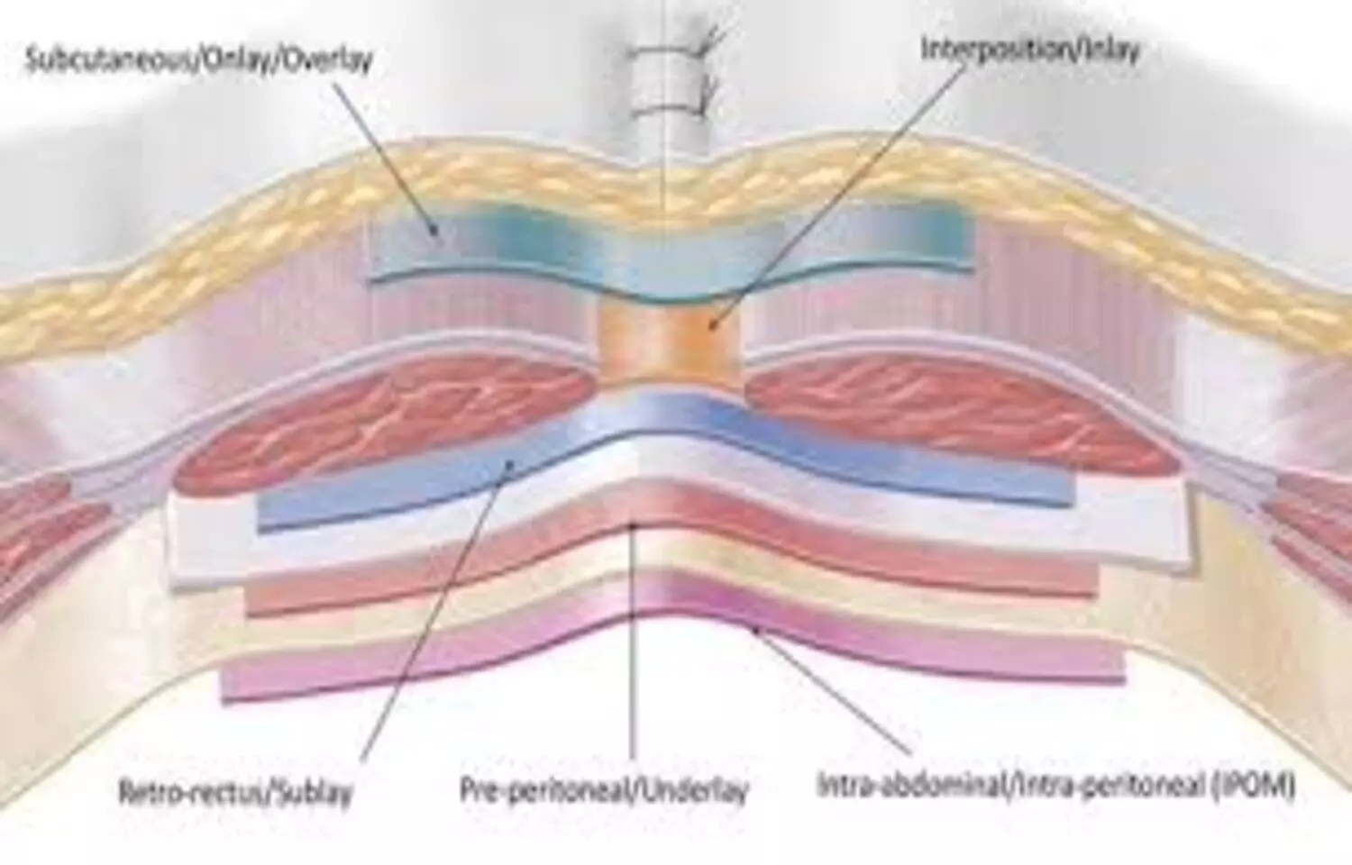 Onlay and Preperitoneal Mesh Placement May Offer Better Outcomes in Primary Ventral Hernia Repair: JAMA