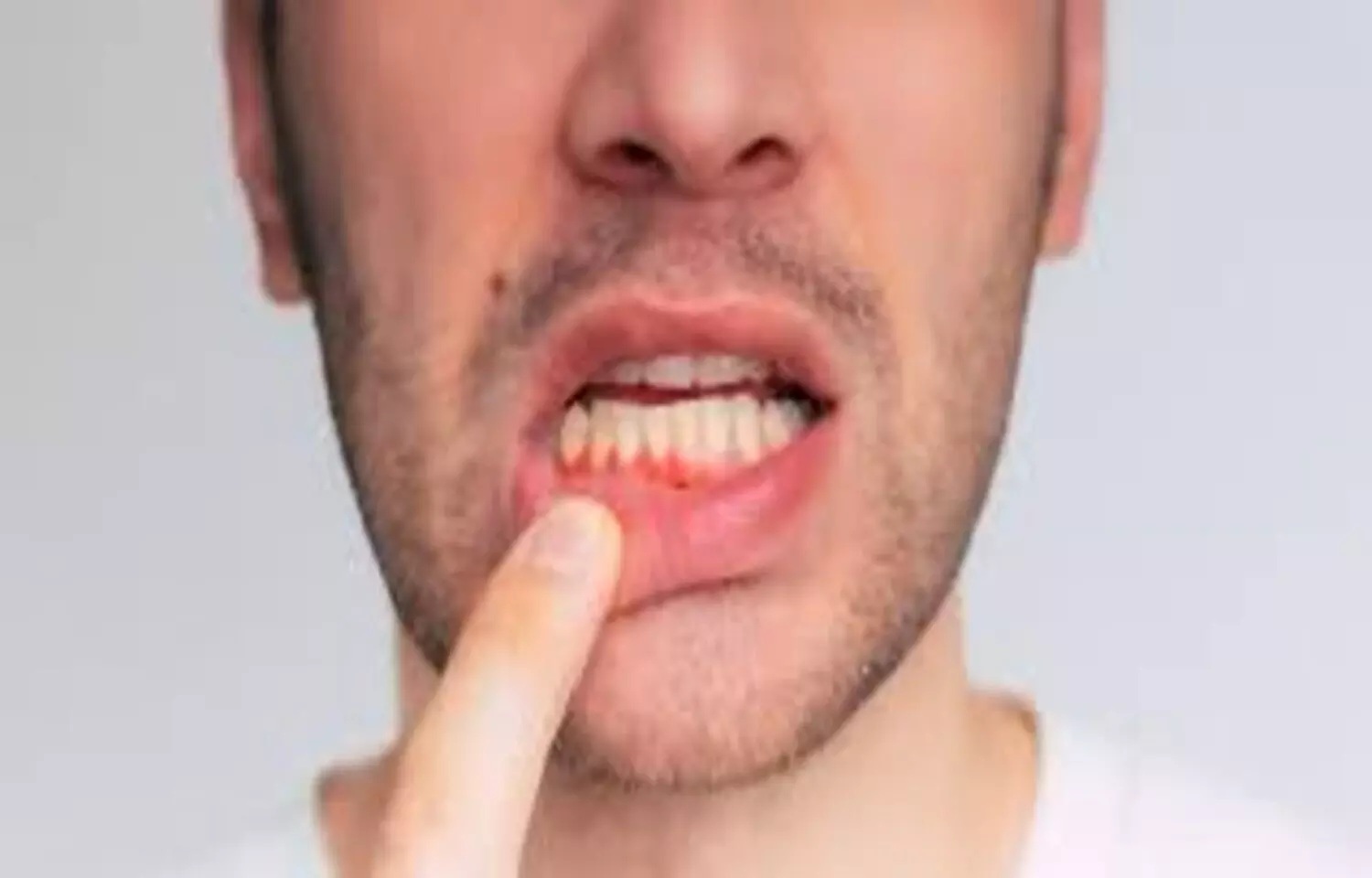 E-Cigarette Use May Be Linked to Poor Oral Health in Youth: Study E-Cigarette Use May Be Linked to Poor Oral Health in Youth: Study