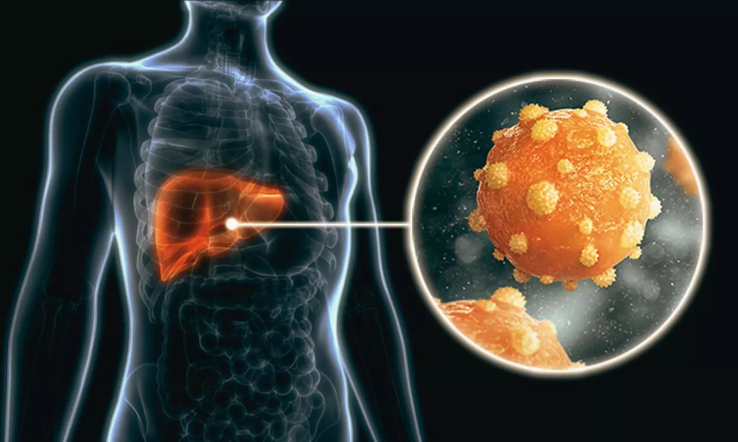 Imdusiran Shows Safety and Tolerability as Potential Functional Cure for Chronic Hepatitis B: NEJM