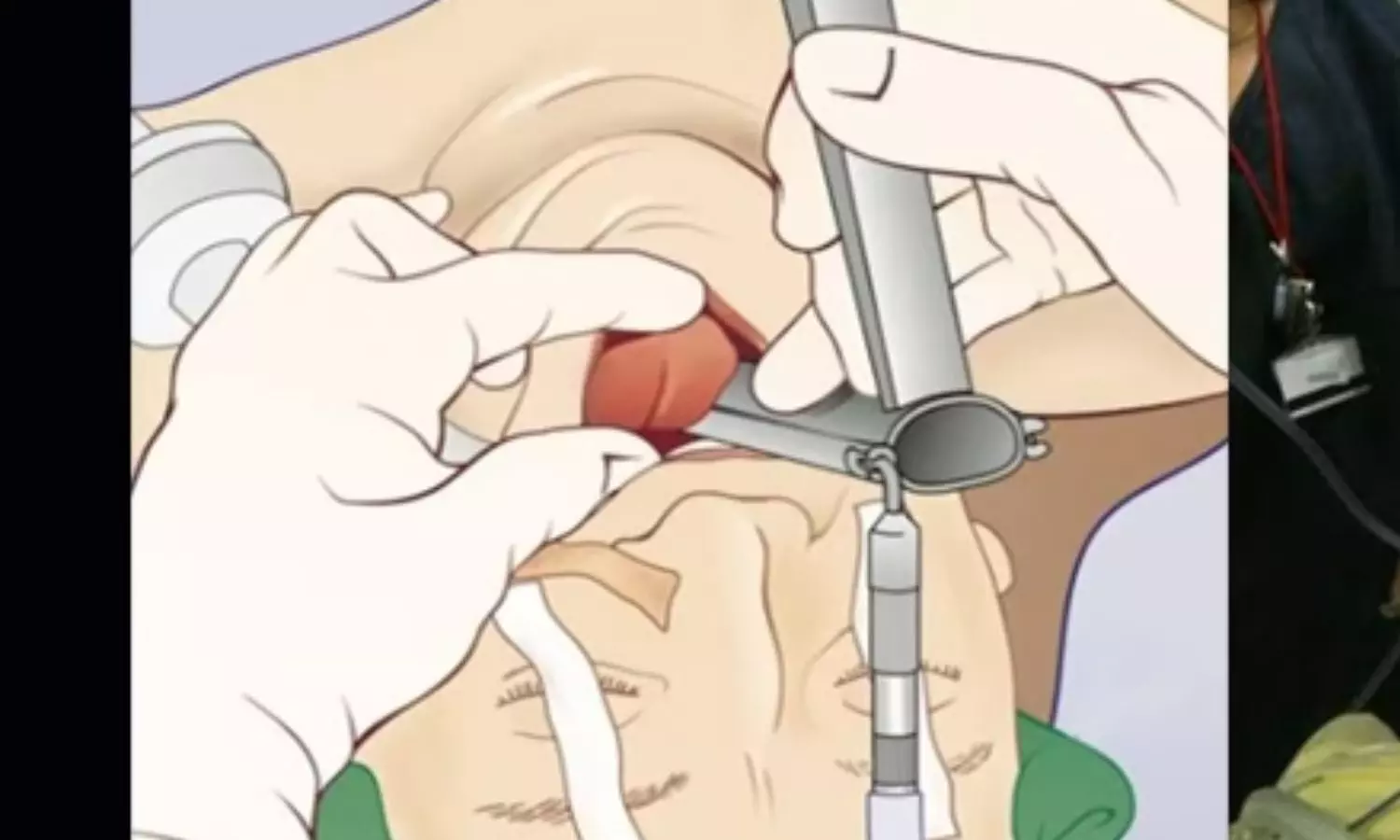 BGH Launches Advanced Rigid Bronchoscope Facility for Emergency Airway Procedures.