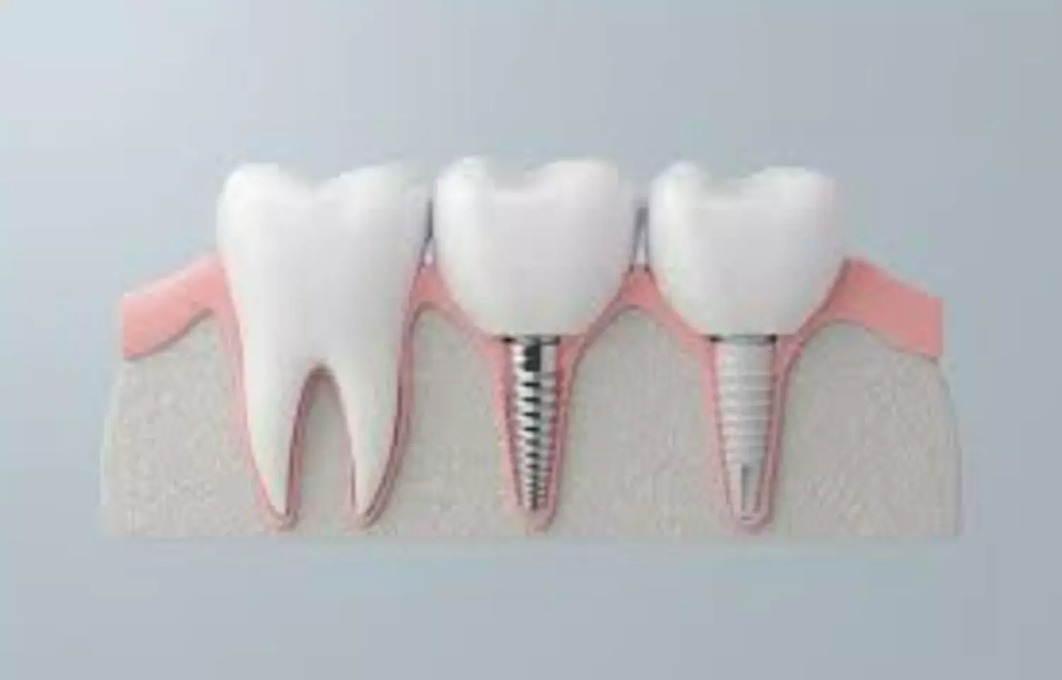 Zirconia Implants Show Comparable Short-Term Outcomes to Titanium Implants: Study Zirconia Implants Show Comparable Short-Term Outcomes to Titanium Implants: Study