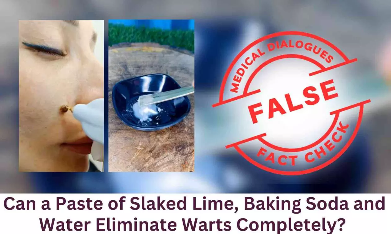 Fact Check: Can a Paste of Slaked Lime, Baking Soda and Water Eliminate Warts Completely? Fact Check: Can a Paste of Slaked Lime, Baking Soda and Water Eliminate Warts Completely?