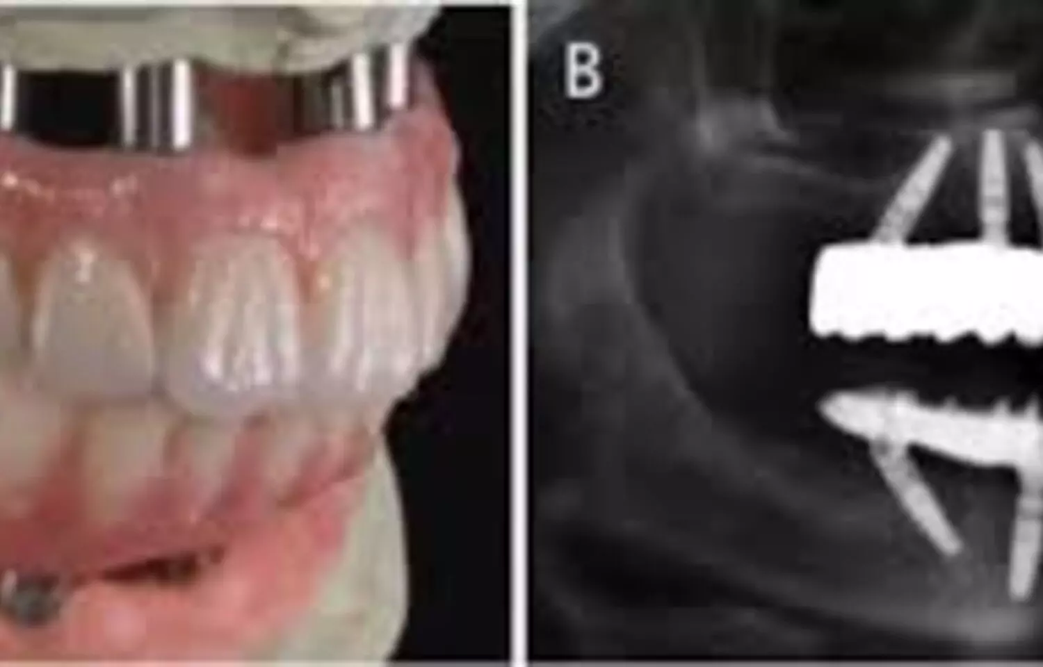 Dual-Hybrid Implant Approach Enhances Tissue Stability and Future Treatment Flexibility: Study Dual-Hybrid Implant Approach Enhances Tissue Stability and Future Treatment Flexibility: Study