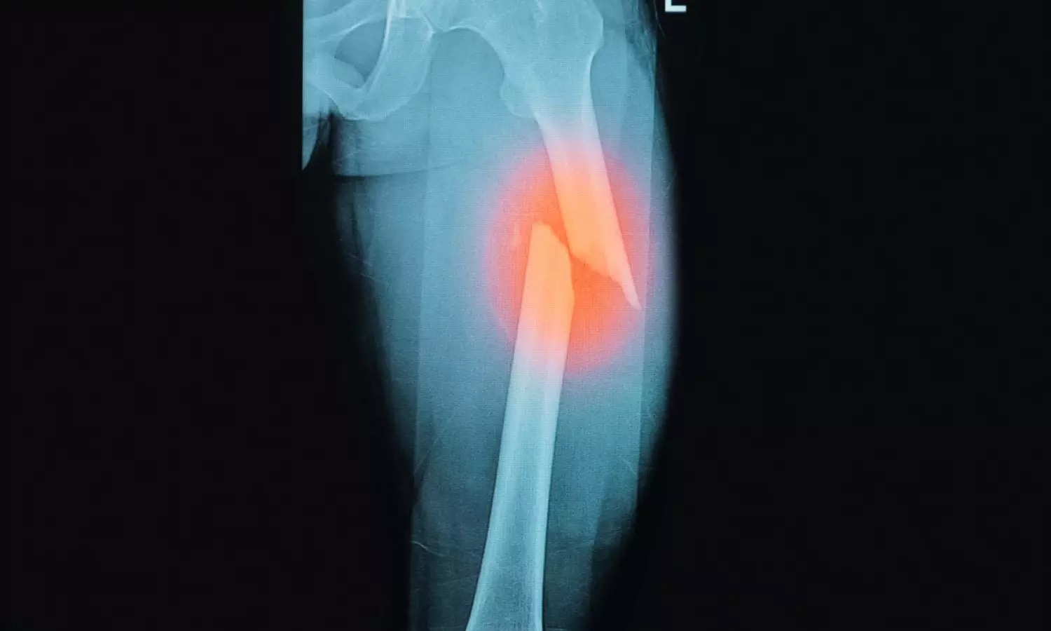 Type 1 Diabetes Linked to Higher Risk of Major Femur and Hip Fractures: Study Type 1 Diabetes Linked to Higher Risk of Major Femur and Hip Fractures: Study