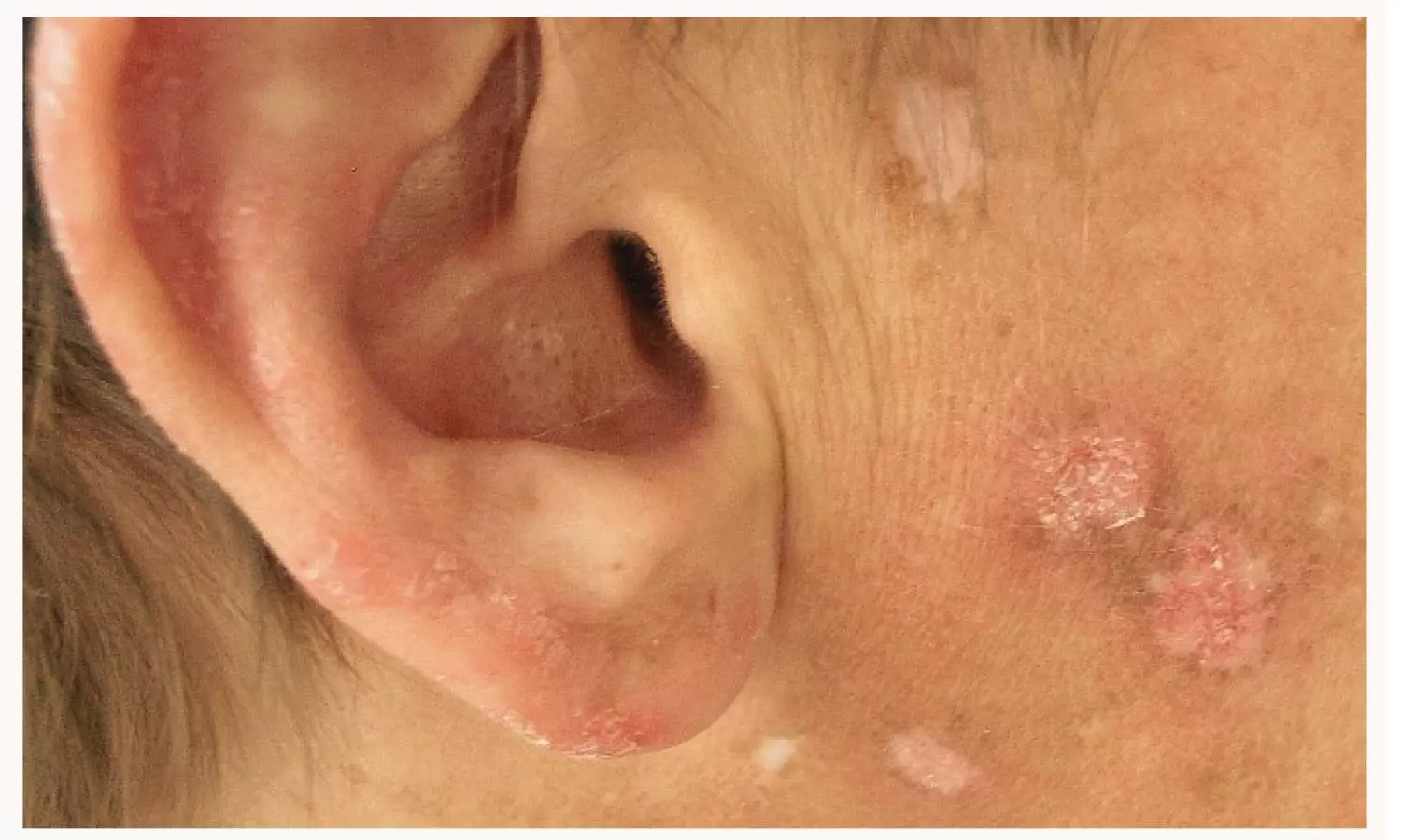 Early HCQS Use Lowers Cardiometabolic Risk in Discoid Lupus: Study Early HCQS Use Lowers Cardiometabolic Risk in Discoid Lupus: Study