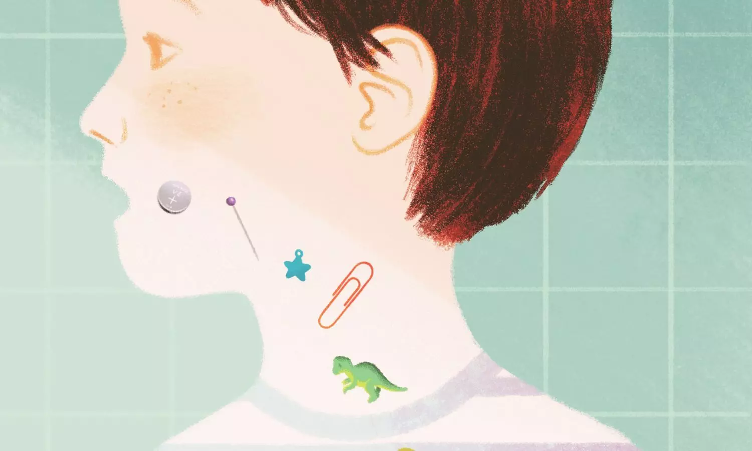 Multiple Magnet Ingestion Linked to Highest Risk of Perforation and Surgery in Children: Study