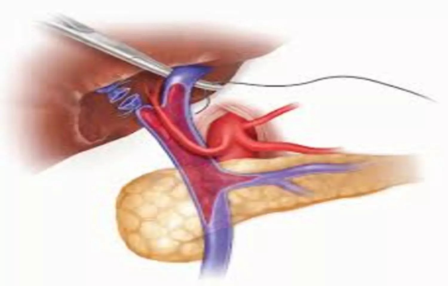 FibroScan and Platelet Count May Help Detect Liver Fibrosis in Children With portal vein thrombosis: Study FibroScan and Platelet Count May Help Detect Liver Fibrosis in Children With portal vein thrombosis: Study