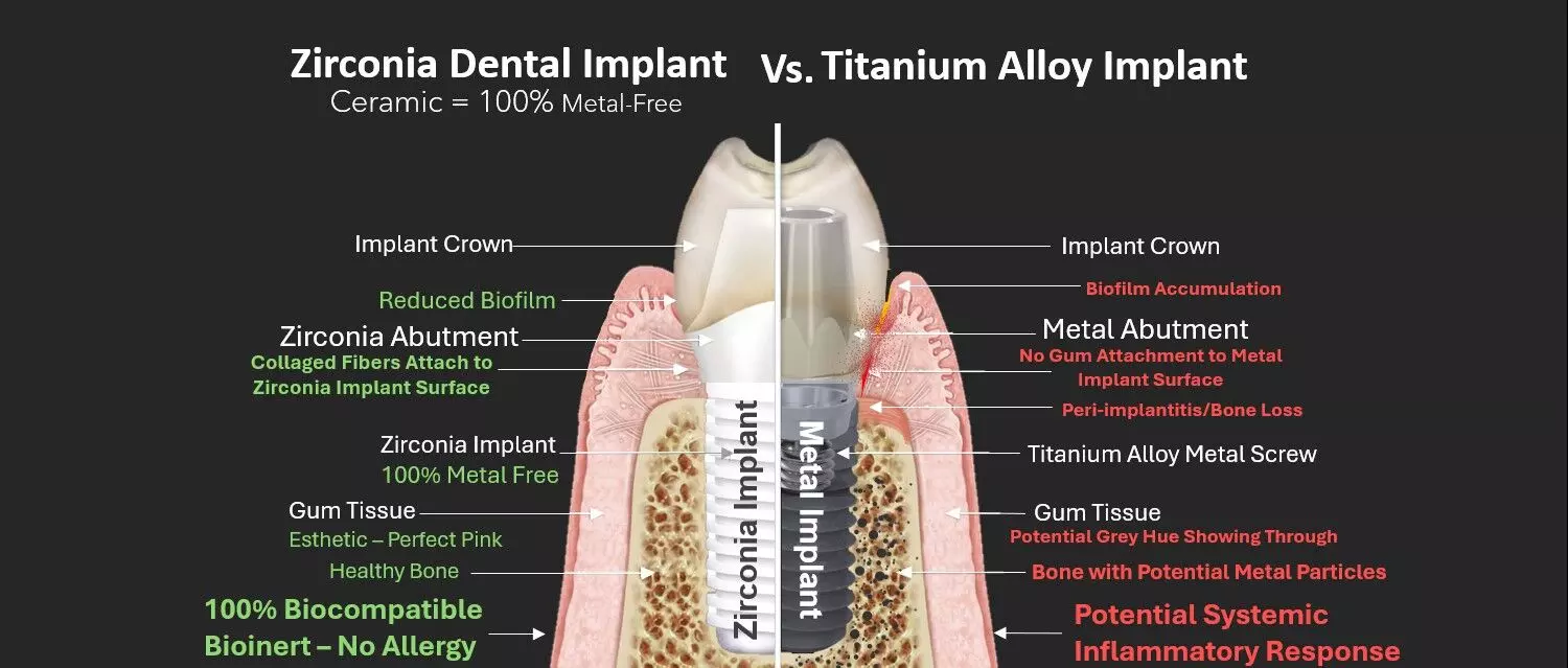 Zirconia Offers Esthetic Advantages, Titanium Remains Gold Standard, suggests study