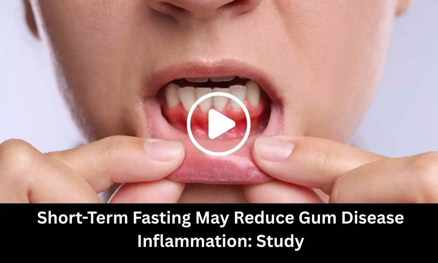 Short-Term Fasting May Reduce Gum Disease Inflammation: Study