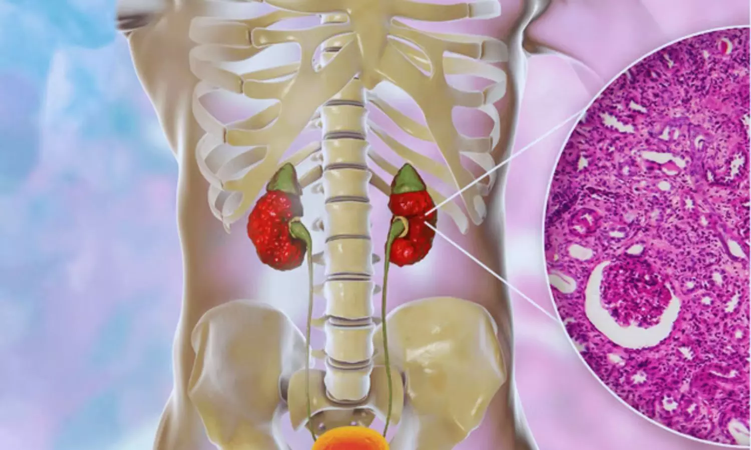 Early Corticosteroid Therapy Improves Long-Term Kidney Recovery in Acute Interstitial Nephritis: Study