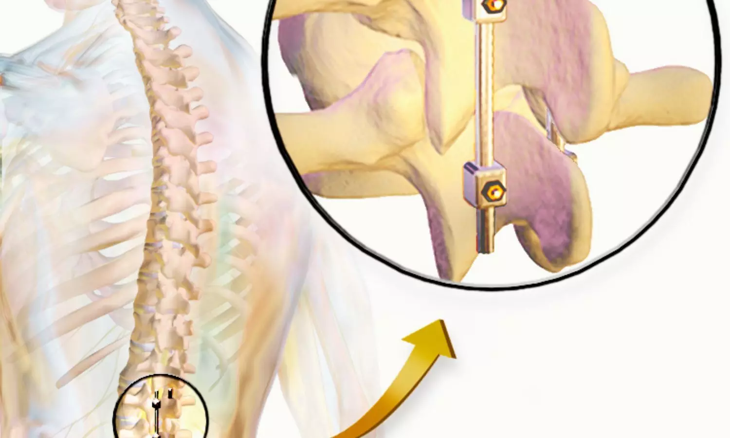 Prehabilitation Improves Surgical Outcomes in Older Adults Undergoing Spinal Fusion: Study Prehabilitation Improves Surgical Outcomes in Older Adults Undergoing Spinal Fusion: Study