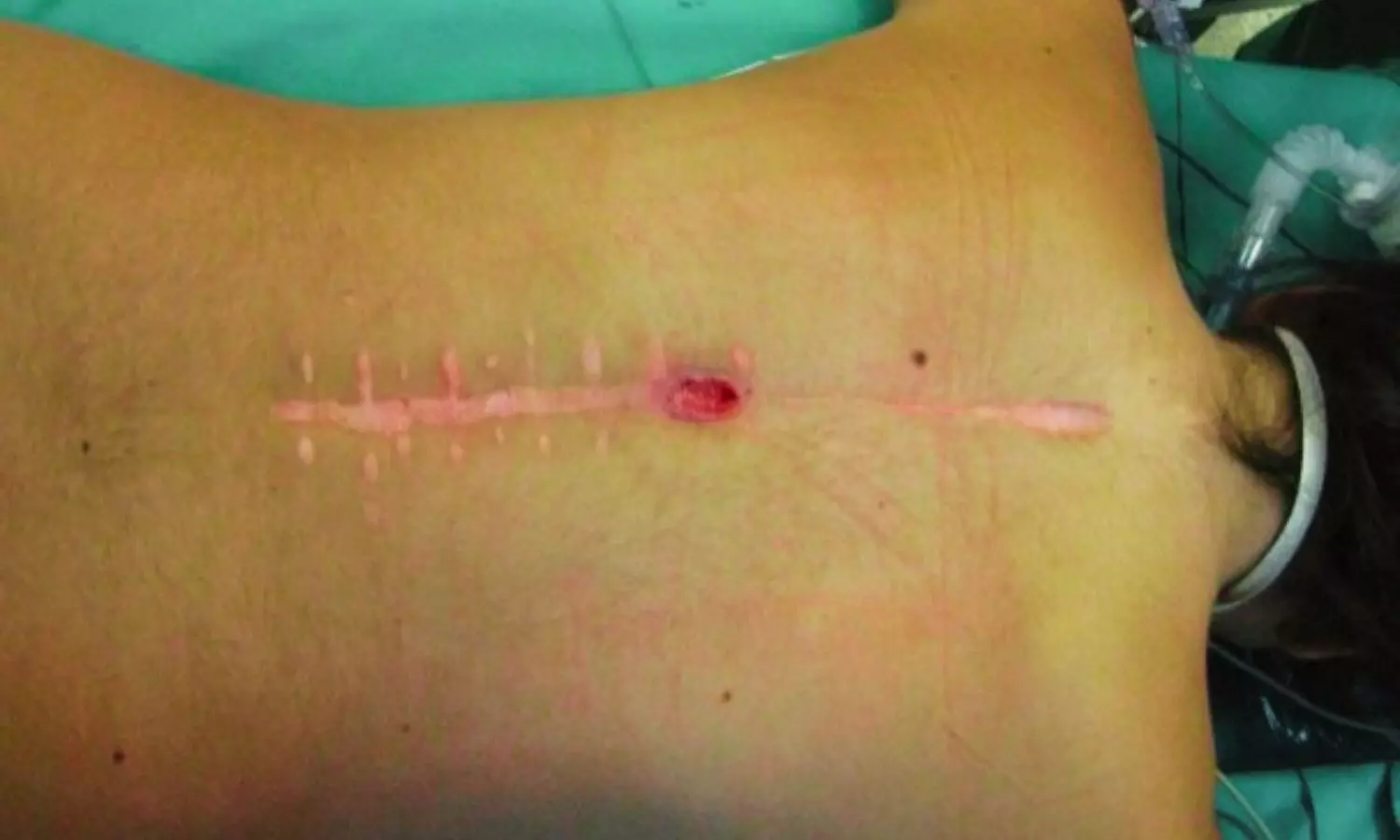 Longer Antibiotic Courses Do Not Improve Outcomes in Acute Spinal Implant Infections: Study