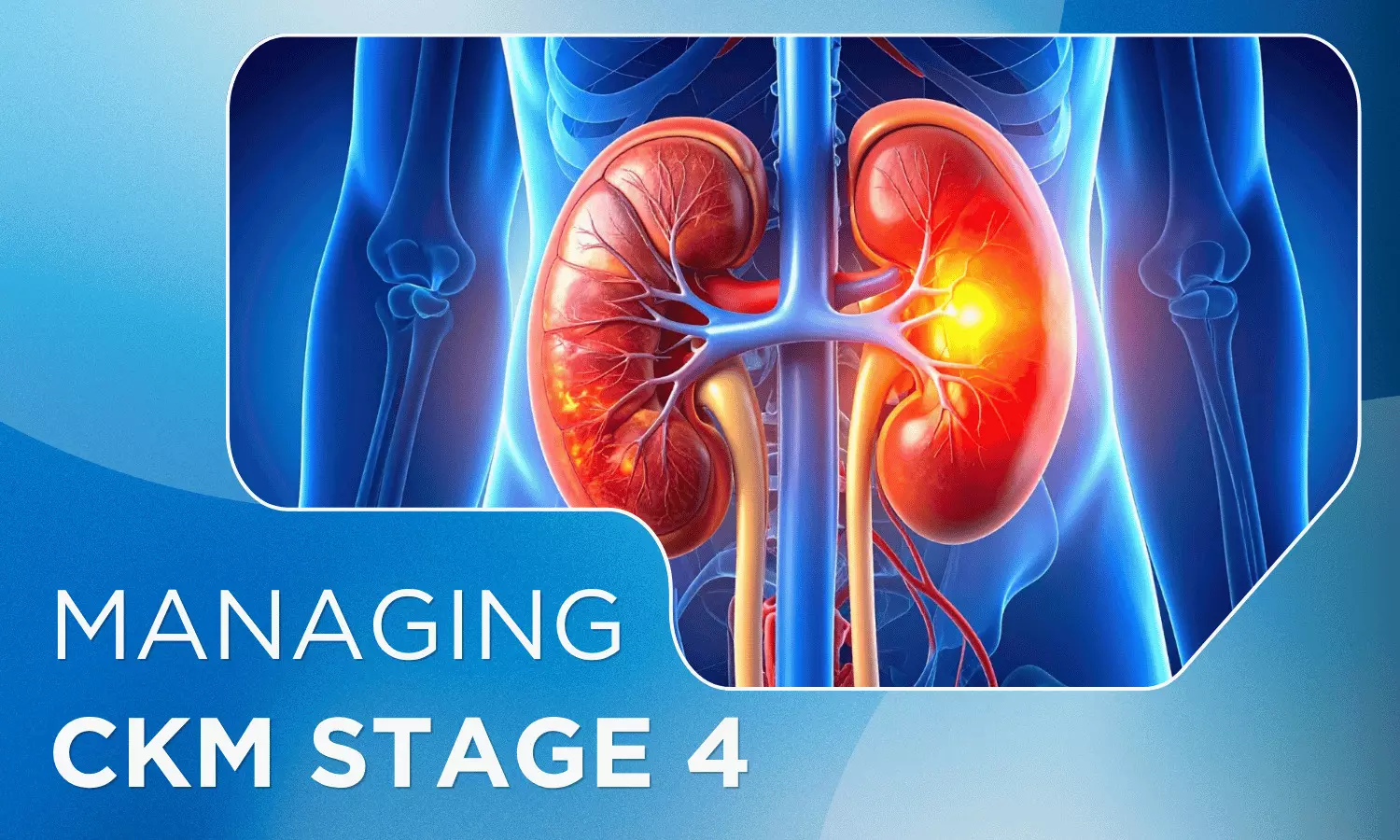 Managing CKM Stage 4: When Cardiovascular Disease Becomes Clinical