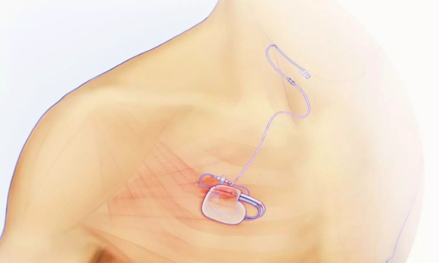 Hypoglossal Nerve Stimulation May Improve Glycemic Control in Patients with Diabetes and OSA: Study