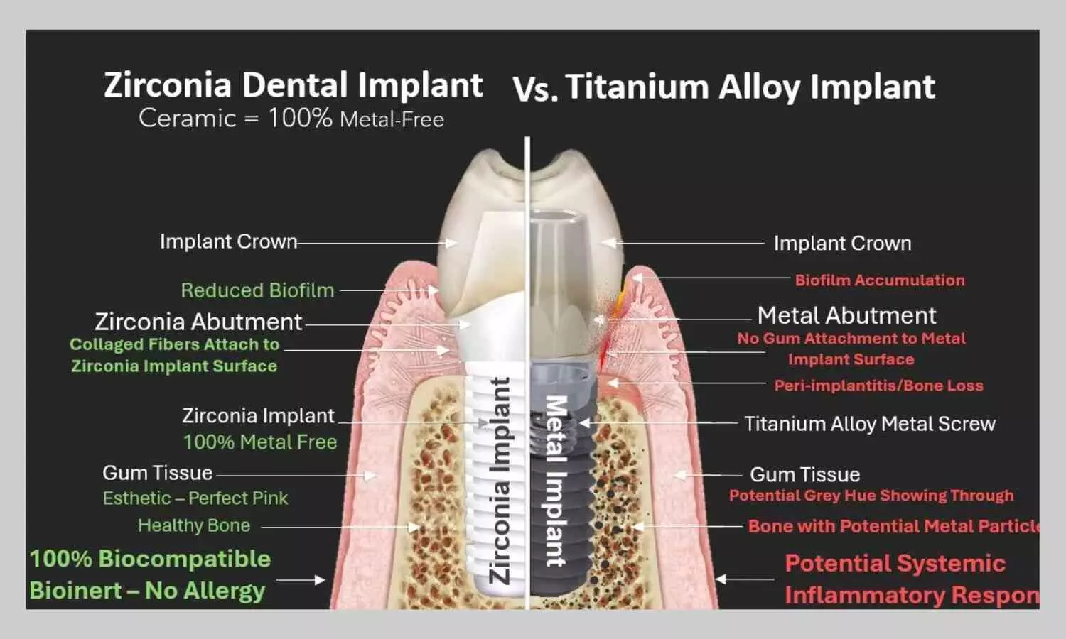 Zirconia Offers Esthetic Advantages, Titanium Remains Gold Standard, suggests study Zirconia Offers Esthetic Advantages, Titanium Remains Gold Standard, suggests study