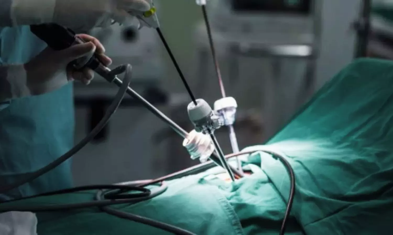 Minimally Invasive Surgery Lowers Inflammation but Not Postoperative Insulin Resistance in Colorectal Cancer Patients: Study Minimally Invasive Surgery Lowers Inflammation but Not Postoperative Insulin Resistance in Colorectal Cancer Patients: Study