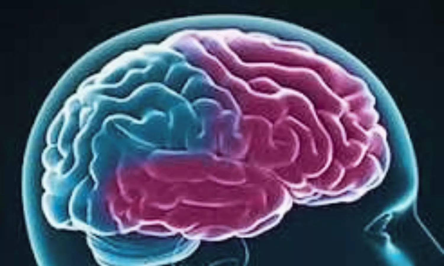 CSF TMEM106B Emerges as a Potential Biomarker for Frontotemporal Lobar Degeneration: JAMA