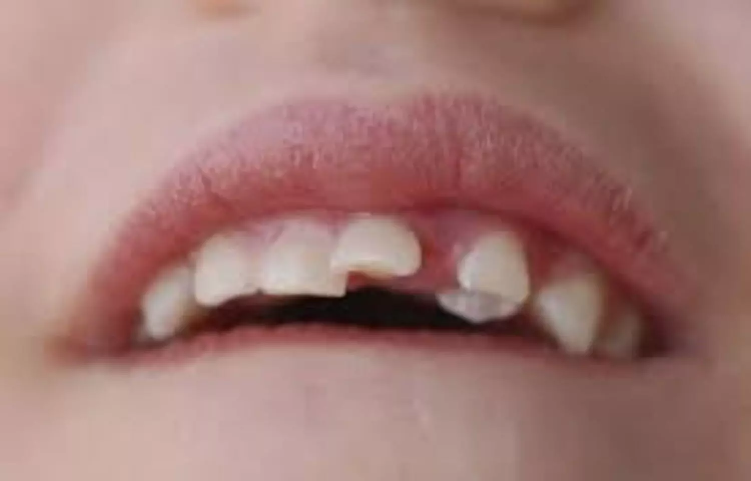 Severe Dental Trauma Significantly Impairs Oral Health-Related Quality of Life: Study Severe Dental Trauma Significantly Impairs Oral Health-Related Quality of Life: Study