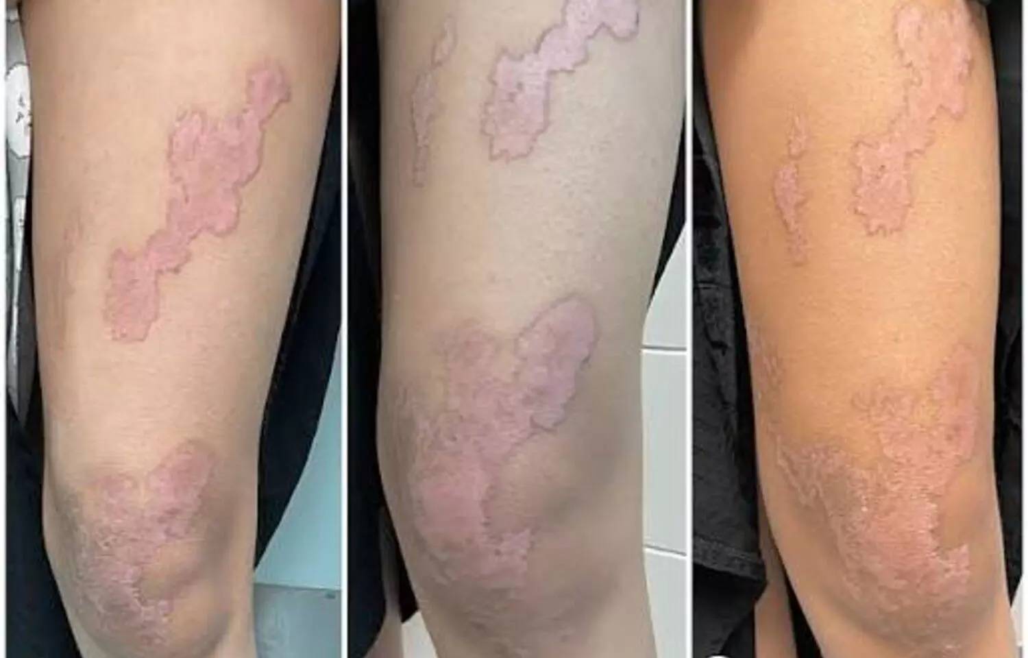 Topical Statins Show Promise as a Safe Treatment for Porokeratosis: A case report Topical Statins Show Promise as a Safe Treatment for Porokeratosis: A case report