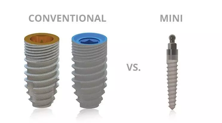 Short-Diameter Implants Comparable to Conventional Implants for Single Crowns: Study