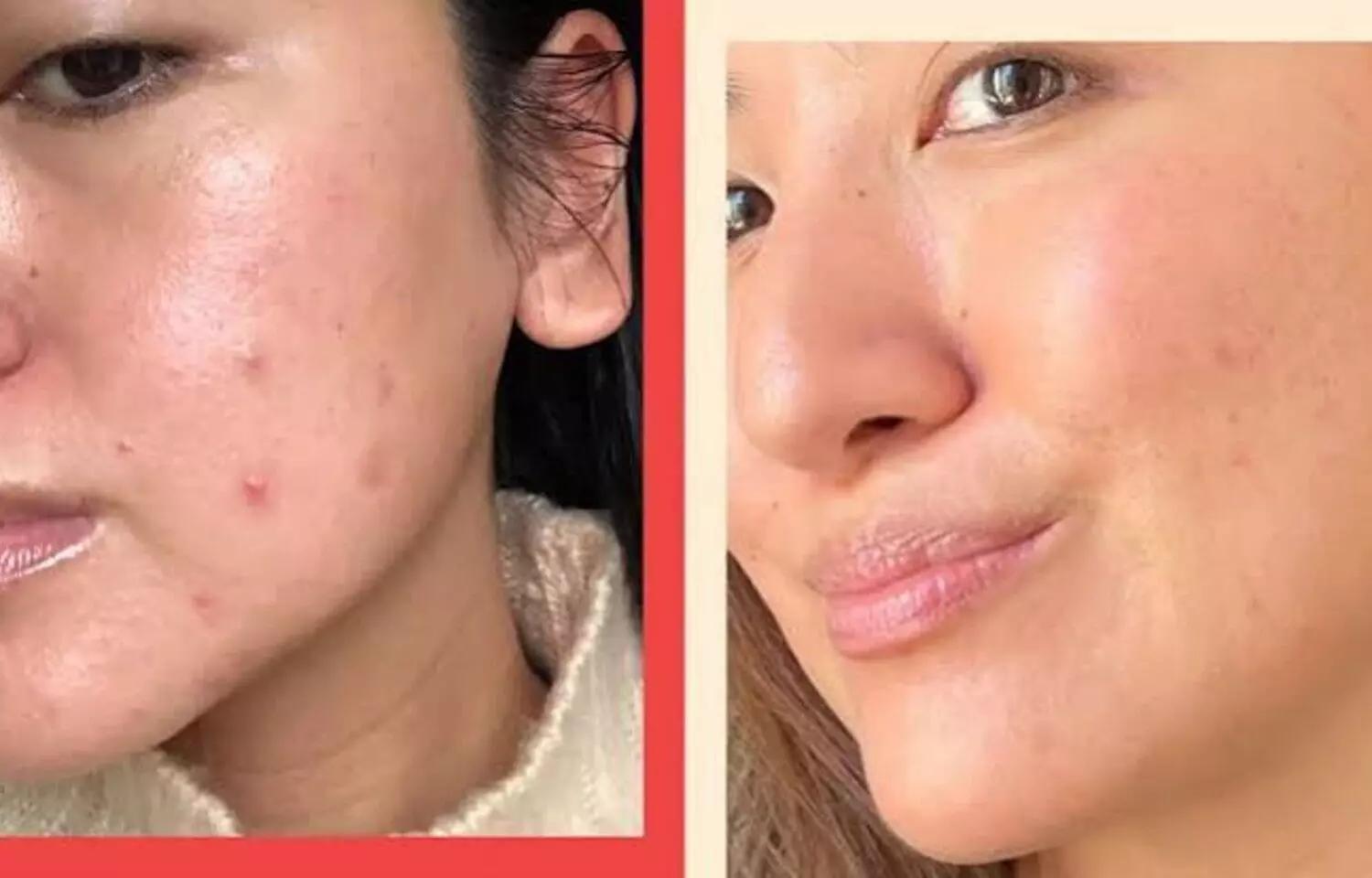 Radiofrequency Microneedling Offers Faster Recovery for Acne Scars: Study