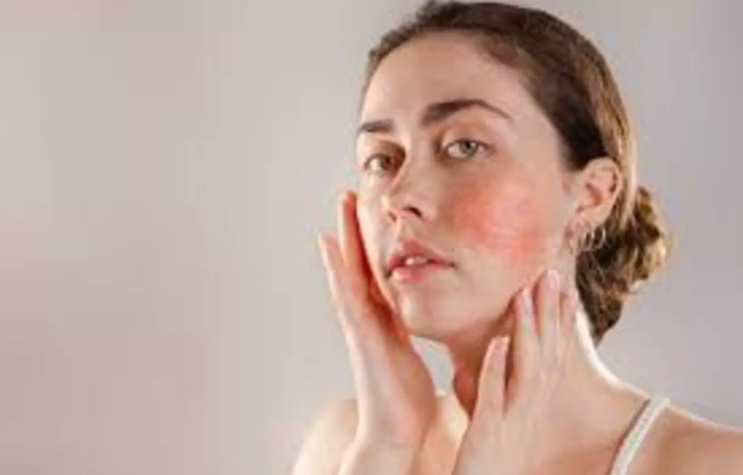 Paroxetine Shows Potential Disease-Modifying Effects in Rosacea: JAMA Paroxetine Shows Potential Disease-Modifying Effects in Rosacea: JAMA