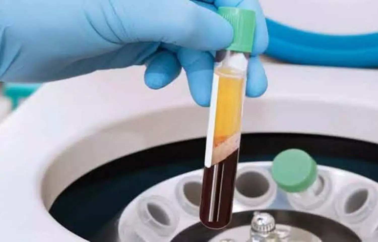 Platelet-Rich Fibrin May Improve Postoperative Outcomes in Oral Surgery, Suggests Study Platelet-Rich Fibrin May Improve Postoperative Outcomes in Oral Surgery, Suggests Study