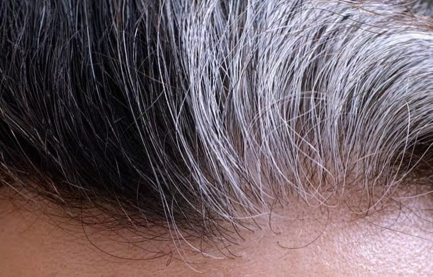 Immunotherapy Associated With Hair Repigmentation, Study Finds